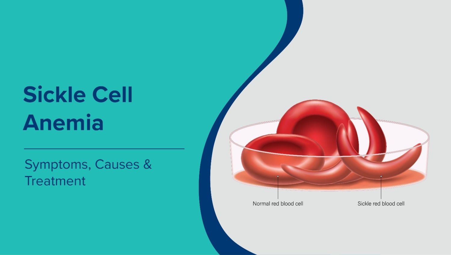 Sickle Cell Anemia: Symptoms, Causes & Treatment